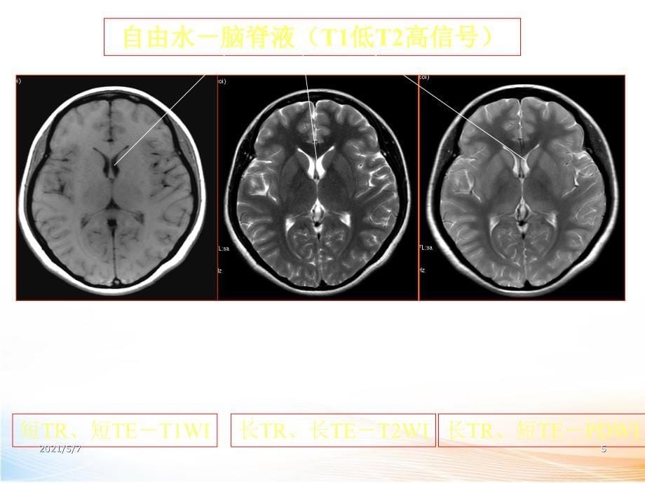 MR基本病变及脑肿瘤见习77页2_第5页