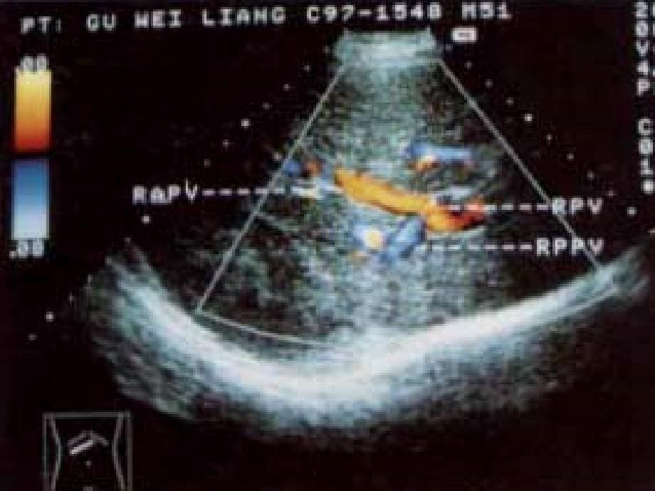超声诊断学1肝脏ppt课件_第5页