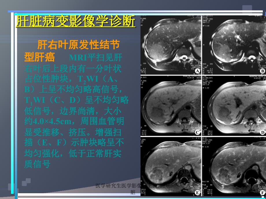 医学研究生医学影像学上腹部1肝脏课件_第3页