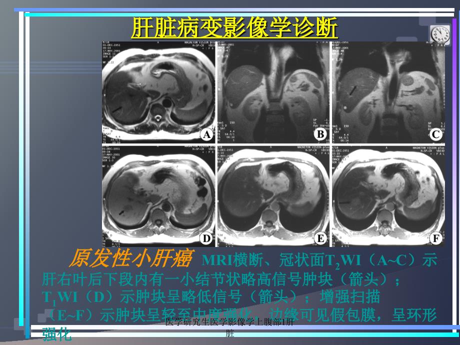 医学研究生医学影像学上腹部1肝脏课件_第4页