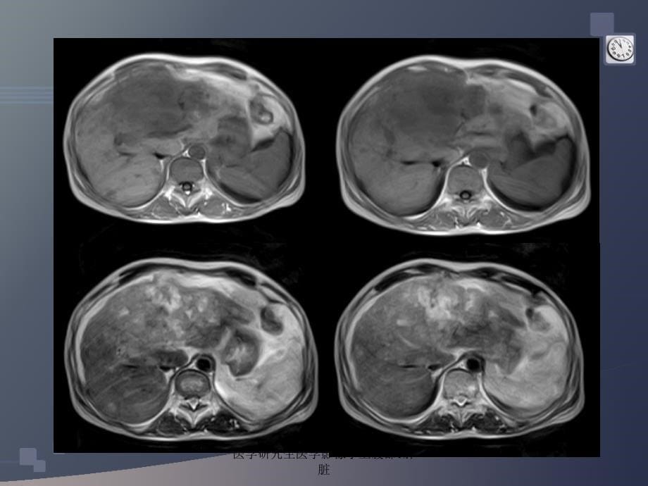 医学研究生医学影像学上腹部1肝脏课件_第5页