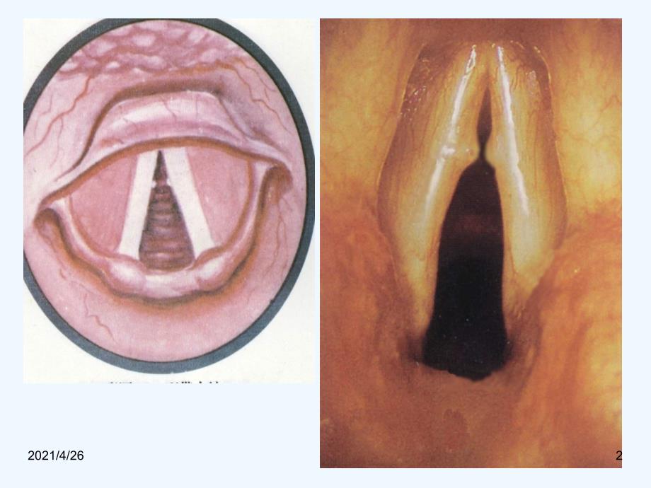 声带小结、息肉_第2页