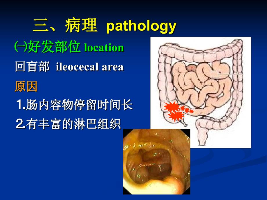 肠结核intestinaltubercul_第4页