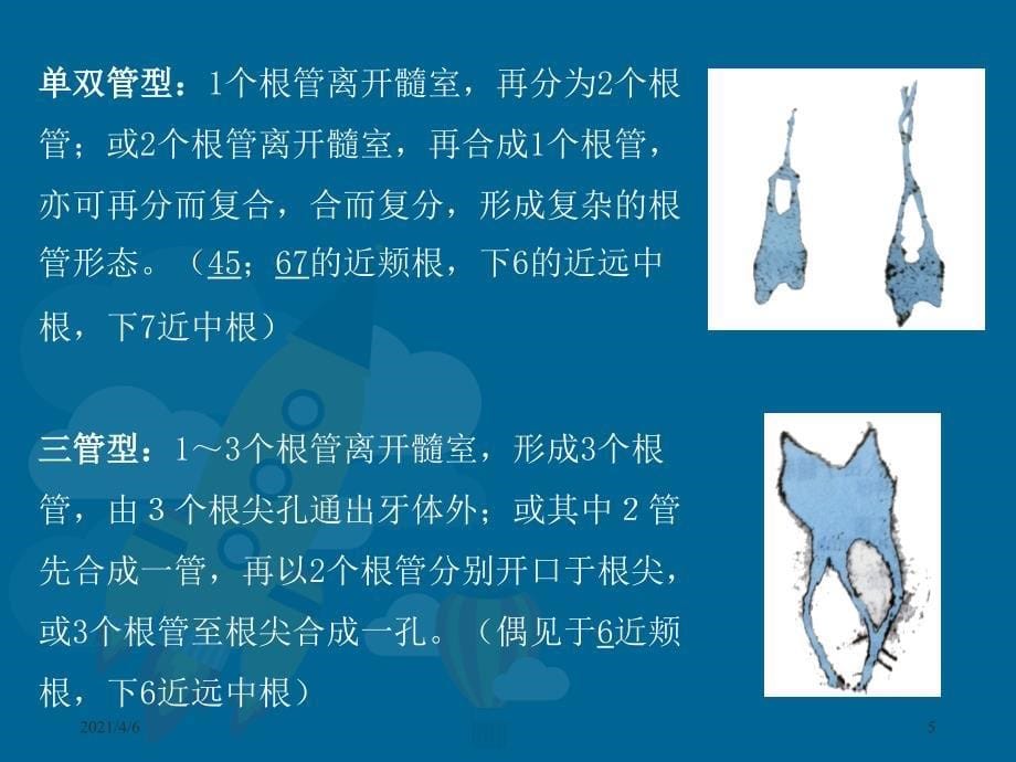 牙髓腔解剖文档资料_第5页