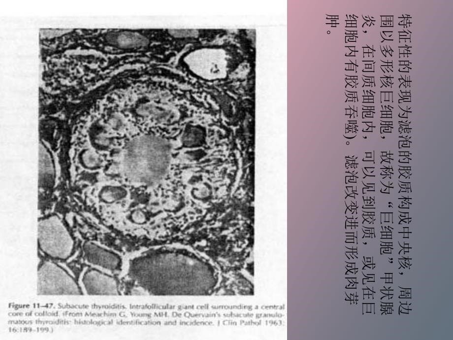 亚急性甲状腺炎五官科_第5页