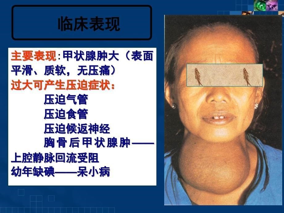 甲状腺疾病内科护理临床部分医学ppt_第5页