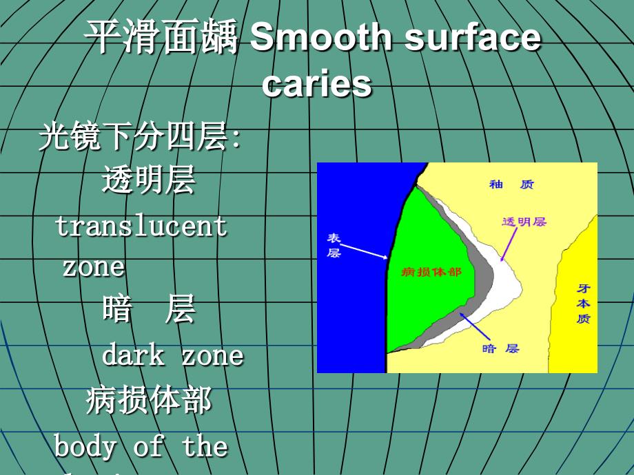 是指发生在牙釉质内的龋浅龋ppt课件_第4页