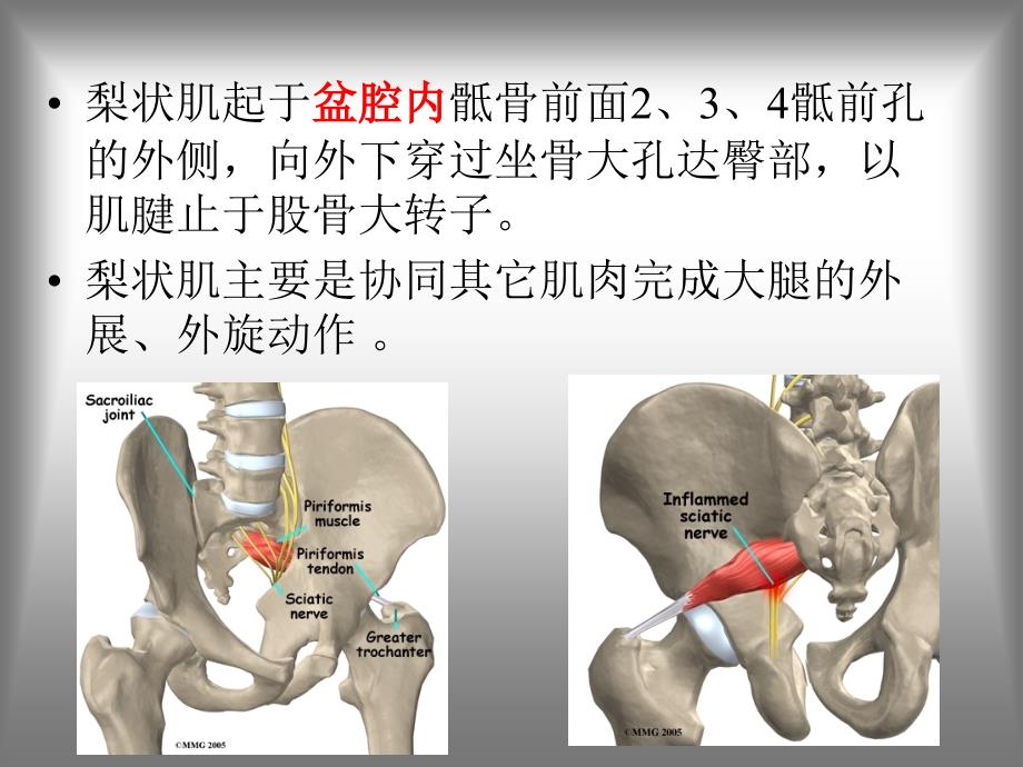 梨状肌综合征课件ppt_第4页