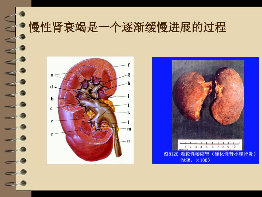 内科学课件：慢性肾衰竭_第3页