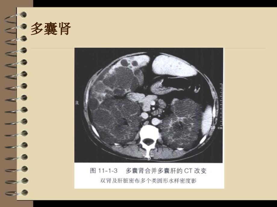 内科学课件：慢性肾衰竭_第4页