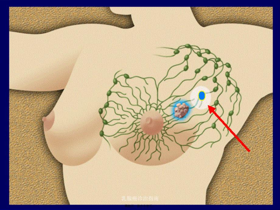 乳腺癌诊治指南课件_第4页