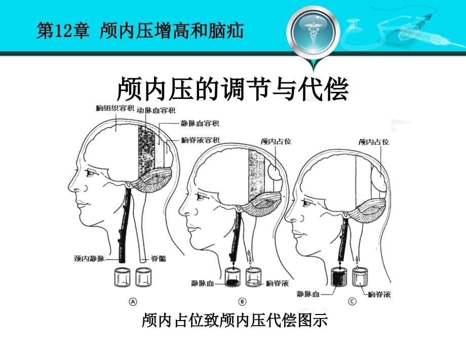 颅内压增高和脑疝课件_第5页