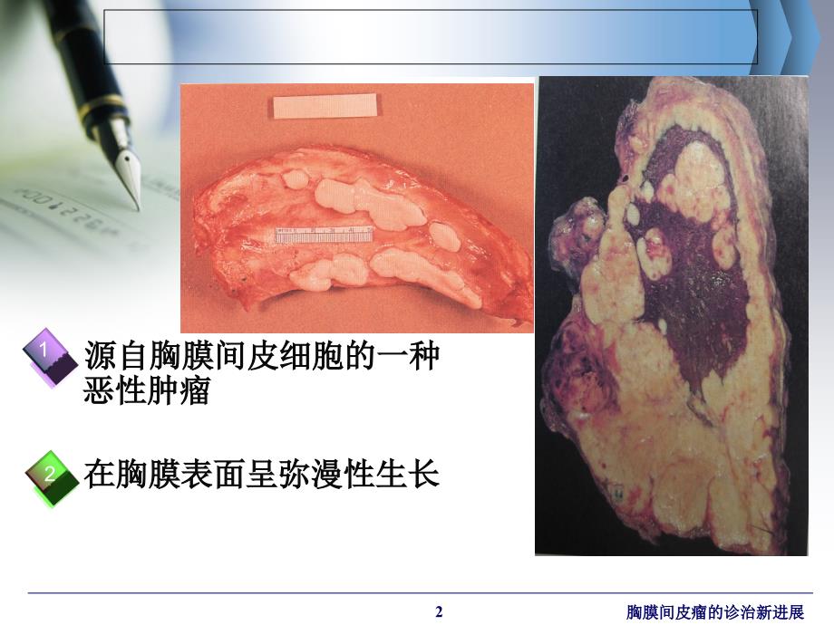 胸膜间皮瘤的诊治新进展ppt课件_第2页