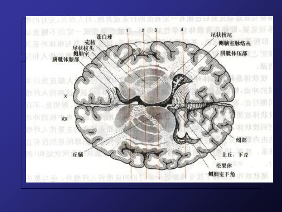 锥体外系疾病_第4页