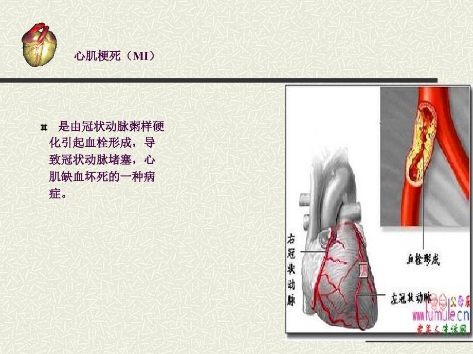 急性心肌梗死健康宣教ppt课件_第2页