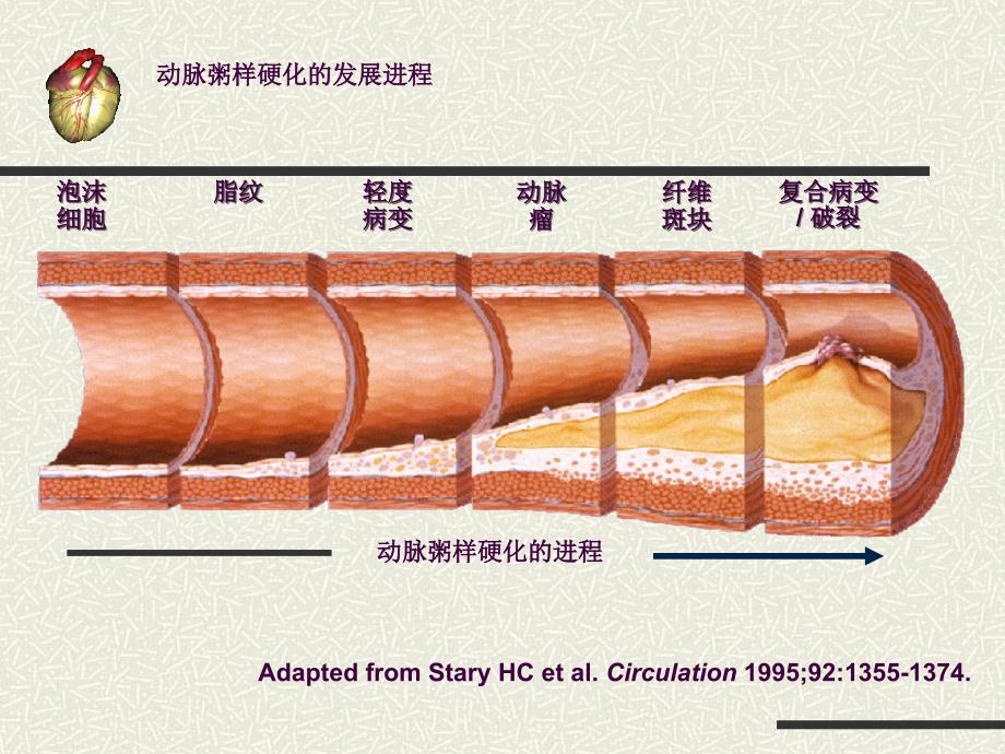 急性心肌梗死健康宣教ppt课件_第3页