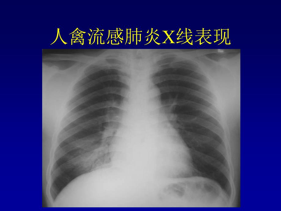 人禽流感肺炎的影像诊断和鉴别诊断_第3页