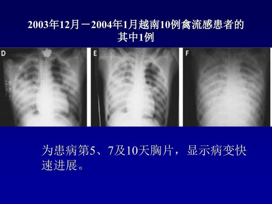 人禽流感肺炎的影像诊断和鉴别诊断_第5页