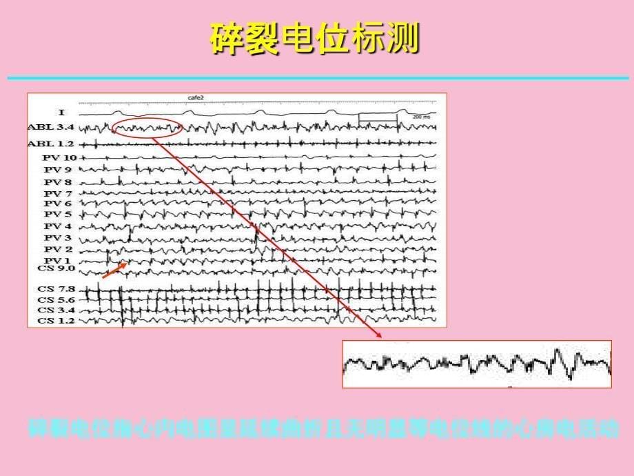 心房碎裂电位区域病理组织学特点ppt课件_第5页