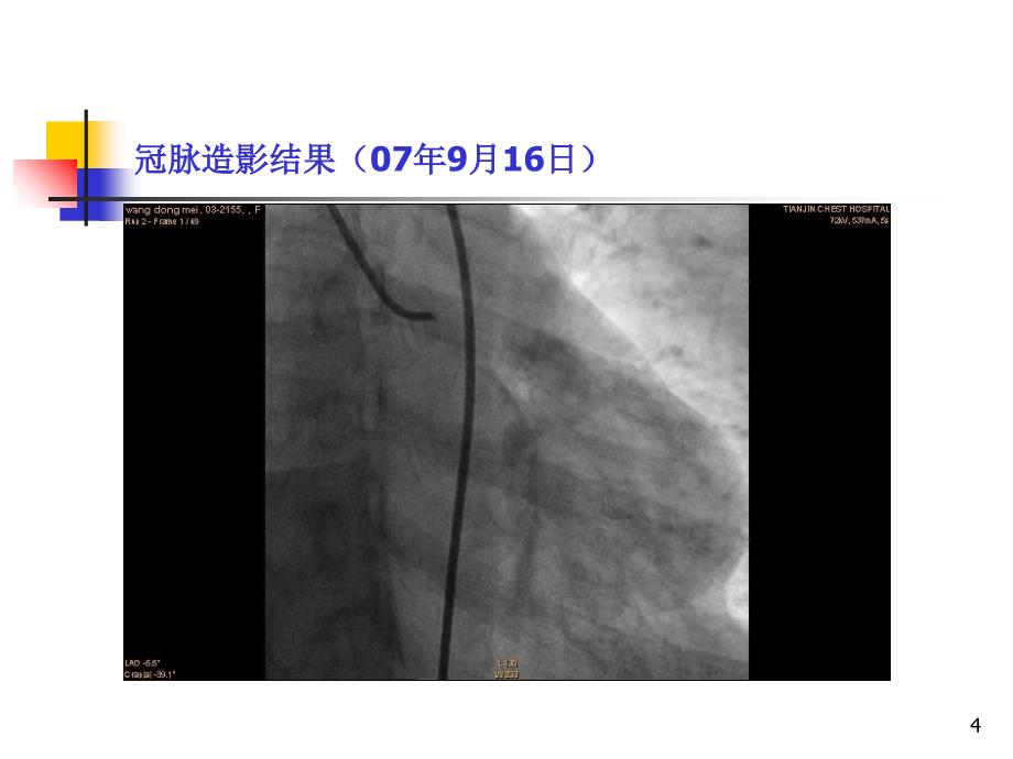 支架内急性血栓形成1例分析参考PPT_第4页