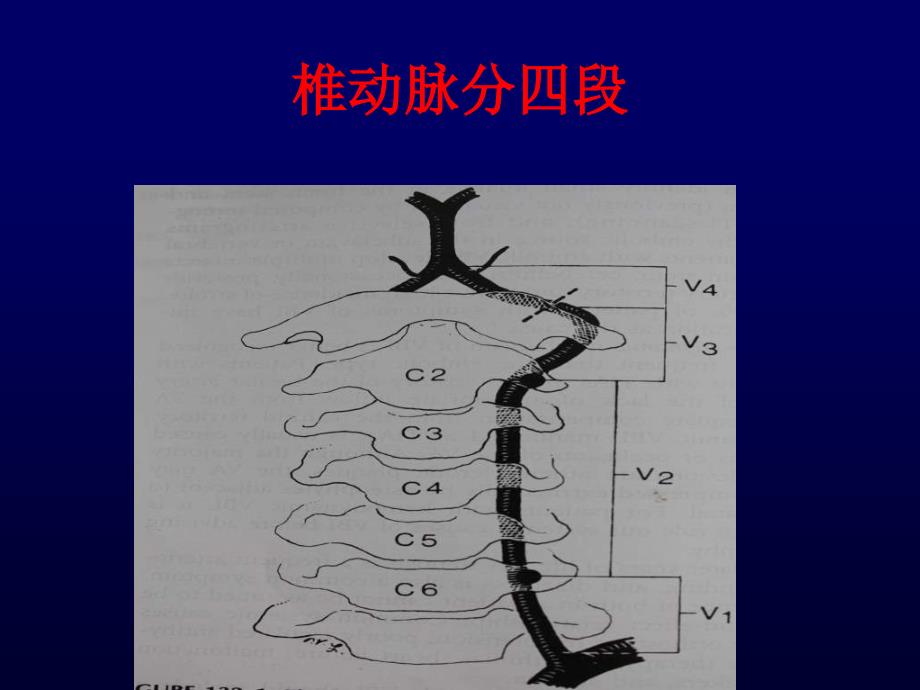 椎动脉病变的手术治疗课件_第3页