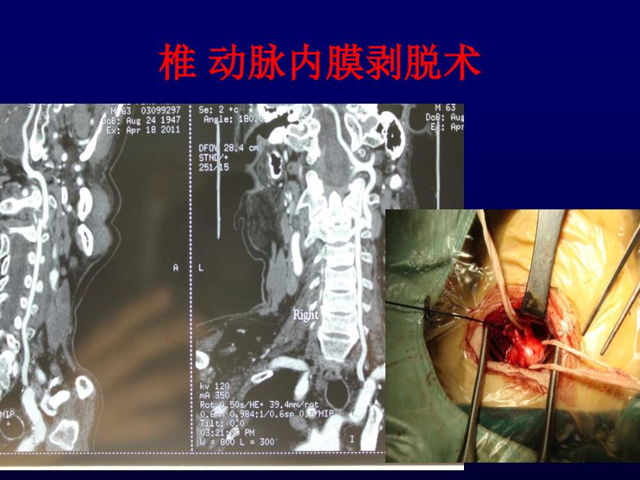 椎动脉病变的手术治疗课件_第4页