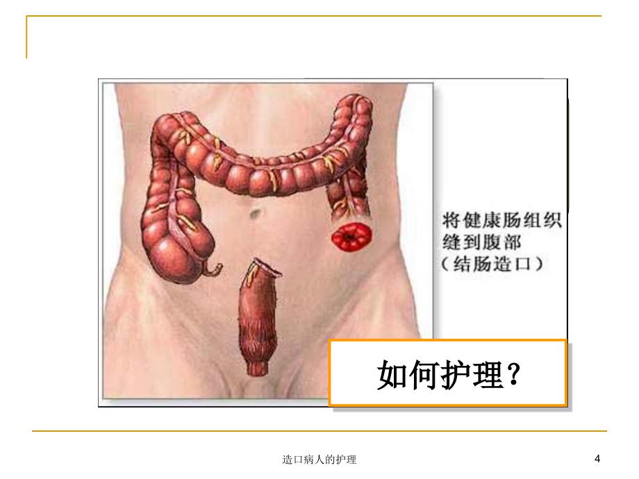 造口病人的护理课件_第4页