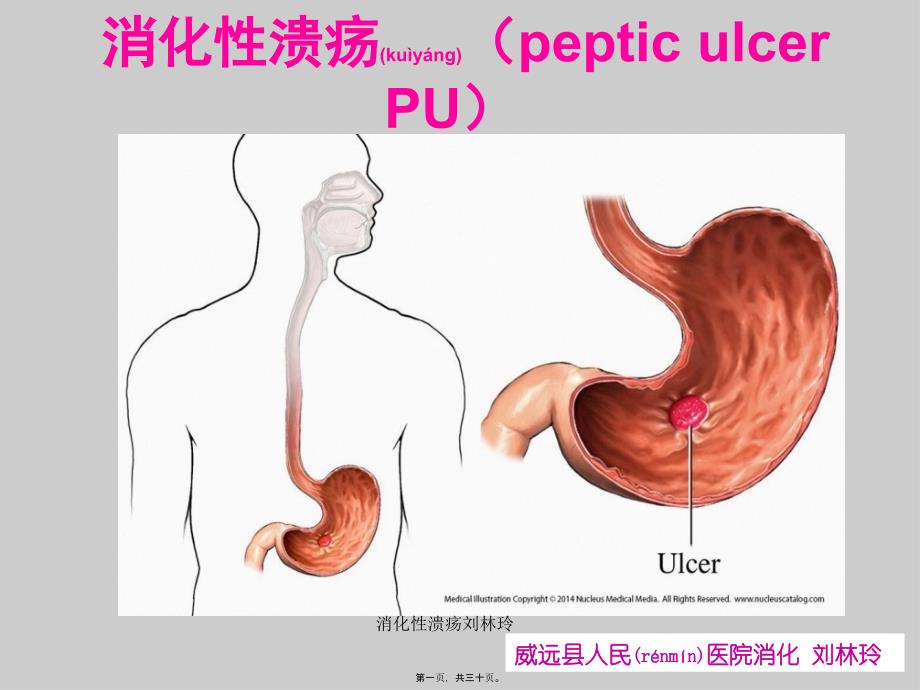 消化性溃疡刘林玲课件_第1页