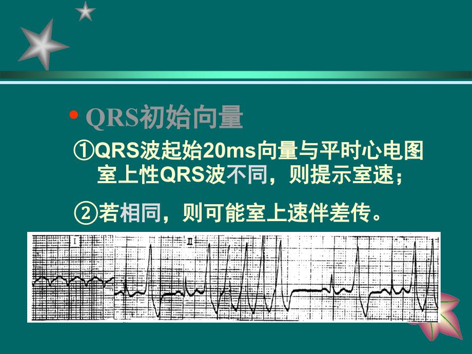 室速的诊断与鉴别诊断PPT_第4页