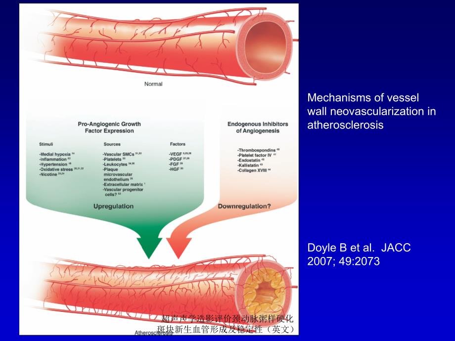 超声声学造影评价颈动脉粥样硬化斑块新生血管形成及稳定性英文课件_第2页