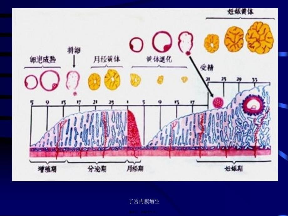 子宫内膜增生课件_第5页