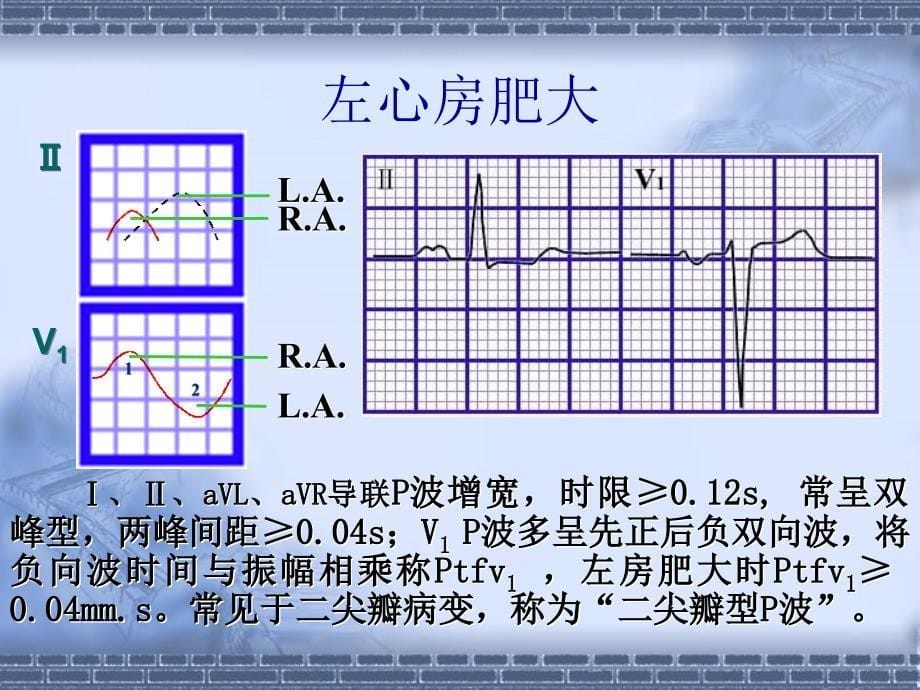 心电图的临床应用1_第5页