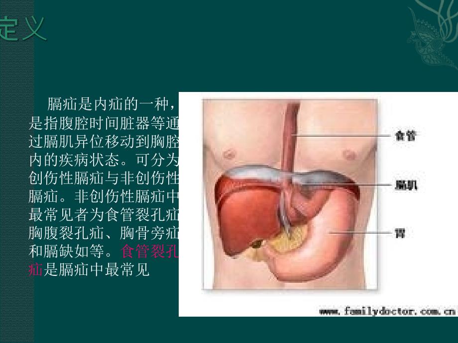 膈疝护理查房_第3页