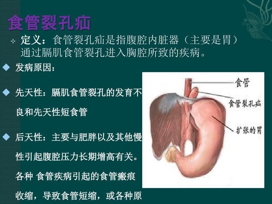 膈疝护理查房_第5页