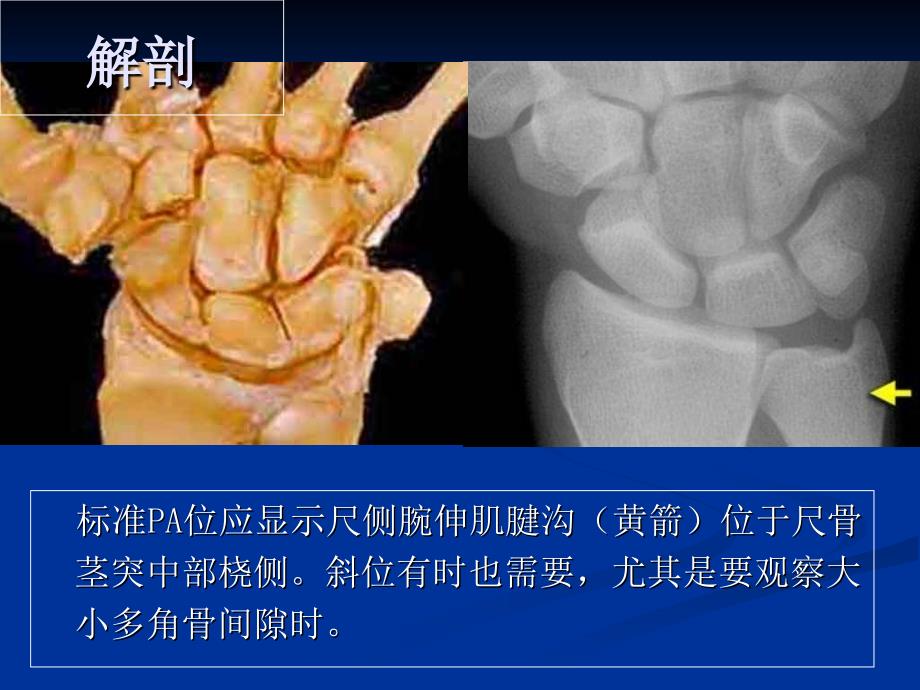 腕关节病变的影像学诊断(1)教学内容_第3页