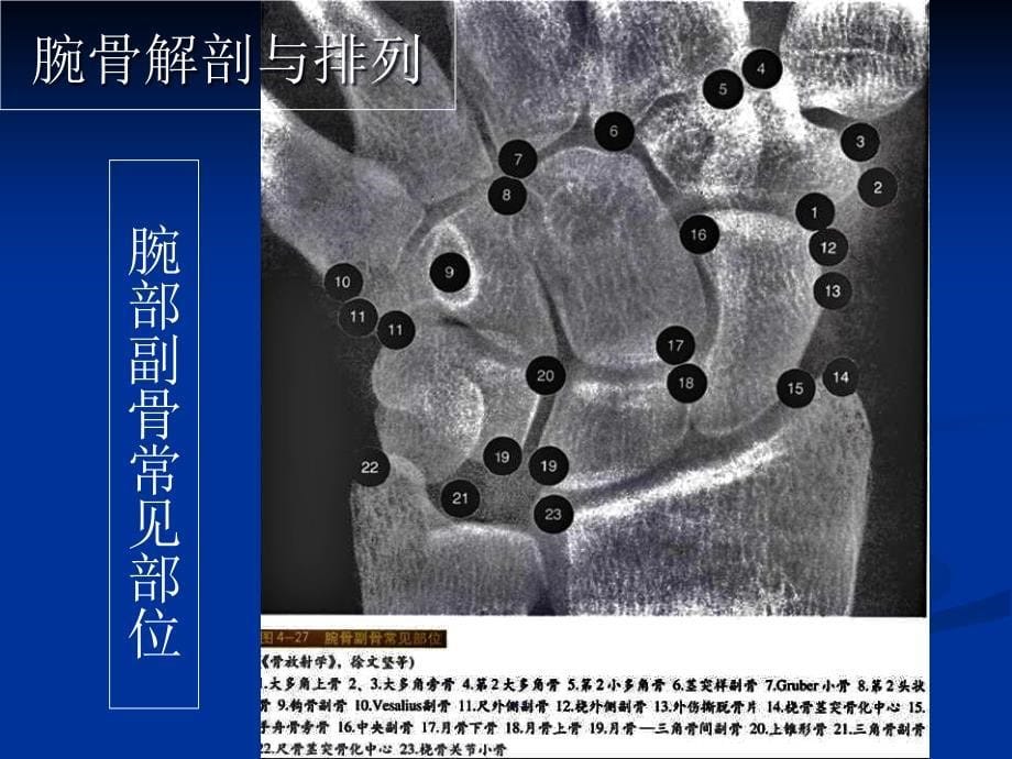 腕关节病变的影像学诊断(1)教学内容_第5页