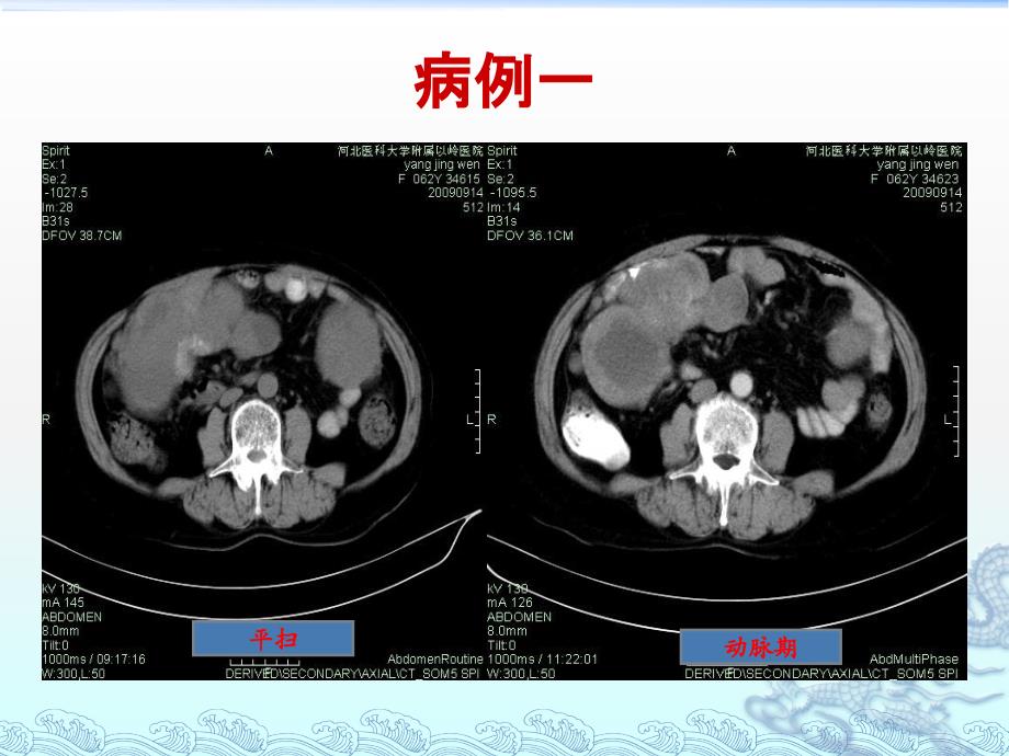 胃肠道间质瘤的影像诊断_第4页