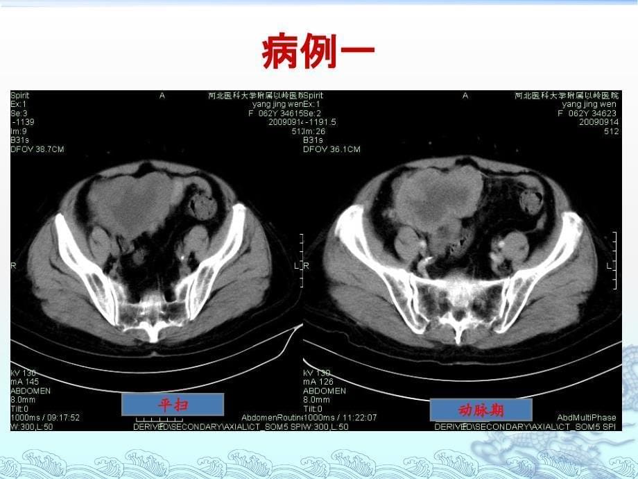 胃肠道间质瘤的影像诊断_第5页