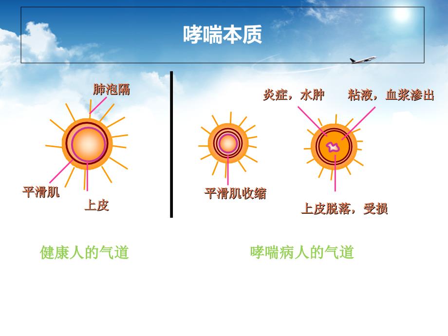 丙酸倍氯米松气雾剂课件_第4页