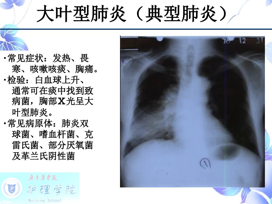 《SARS病人的护理》.ppt_第2页