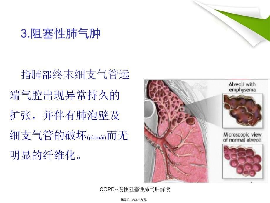 COPD--慢性阻塞性肺气肿解读课件_第5页