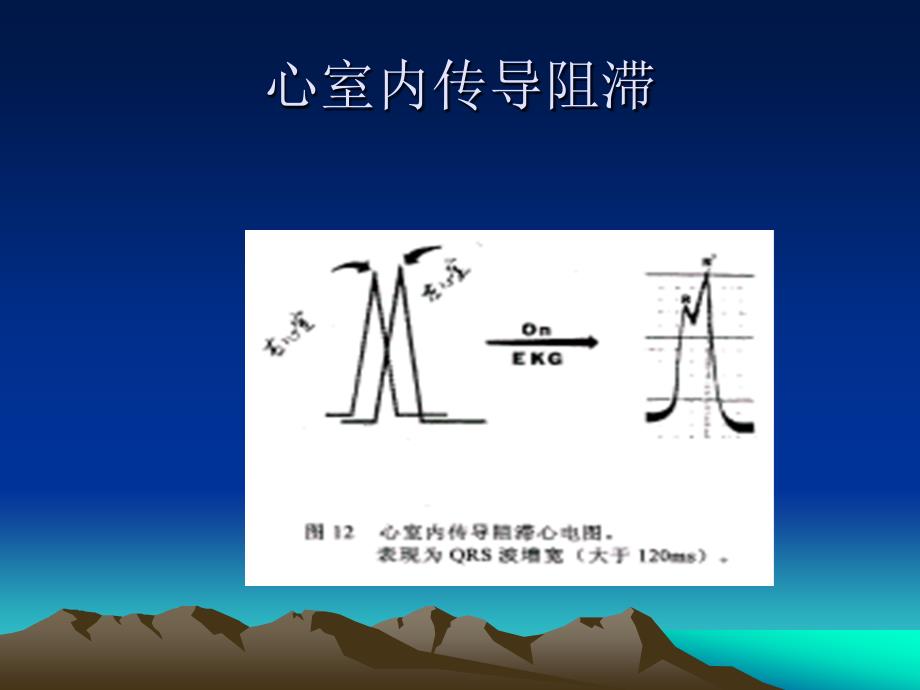 心力衰竭患者心脏再同步治疗及猝死的预防CRTICD适应证课件幻灯PPT_第4页