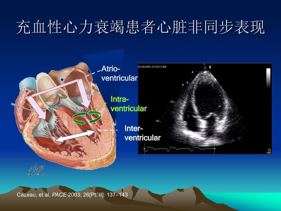 心力衰竭患者心脏再同步治疗及猝死的预防CRTICD适应证课件幻灯PPT_第5页