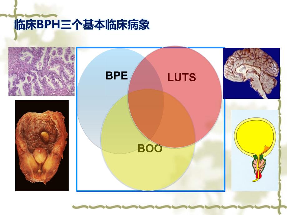 尿动力学检查在BPH诊断中的应用_第4页