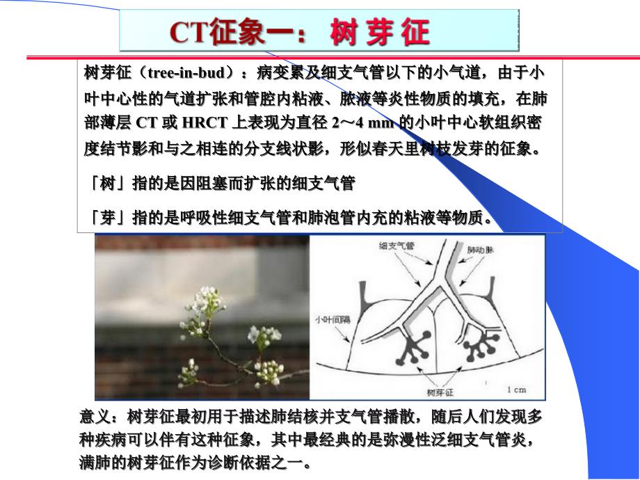 肺部CT十大征象诊断应用_第2页