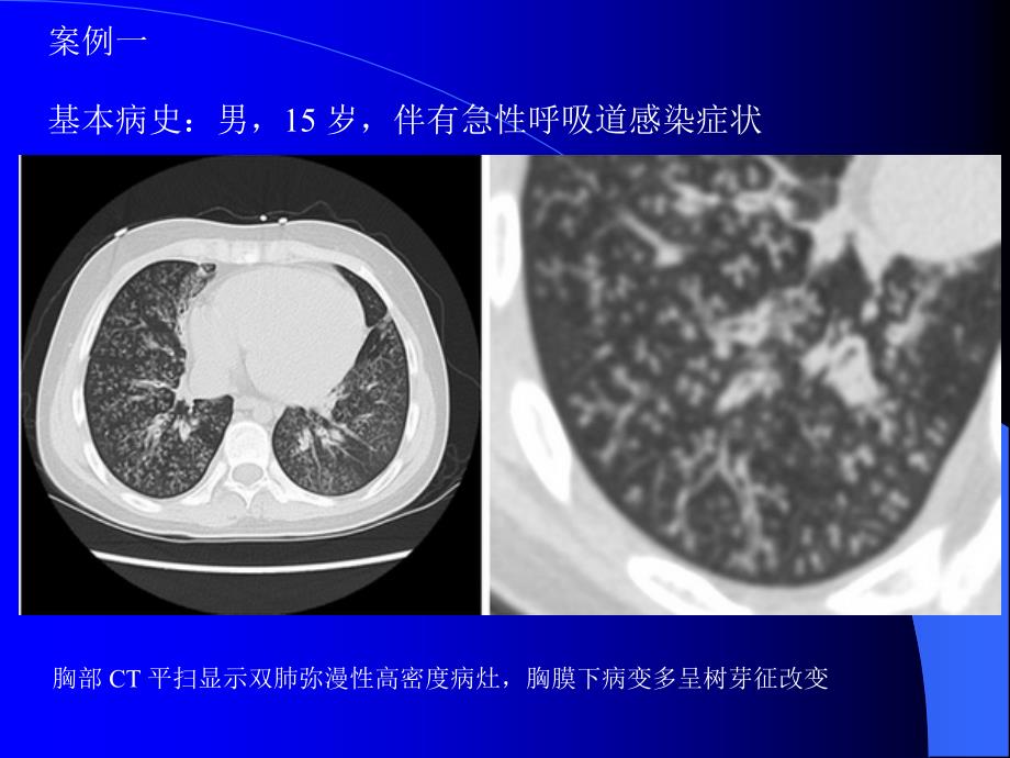 肺部CT十大征象诊断应用_第3页