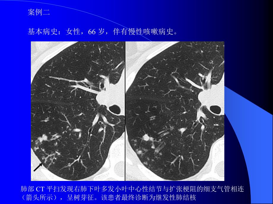 肺部CT十大征象诊断应用_第4页