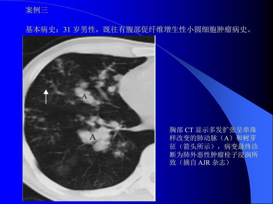 肺部CT十大征象诊断应用_第5页