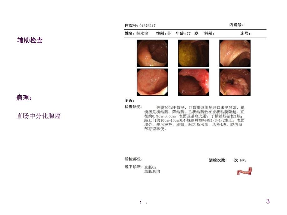 直肠癌术后吻合口出血ppt课件_第3页