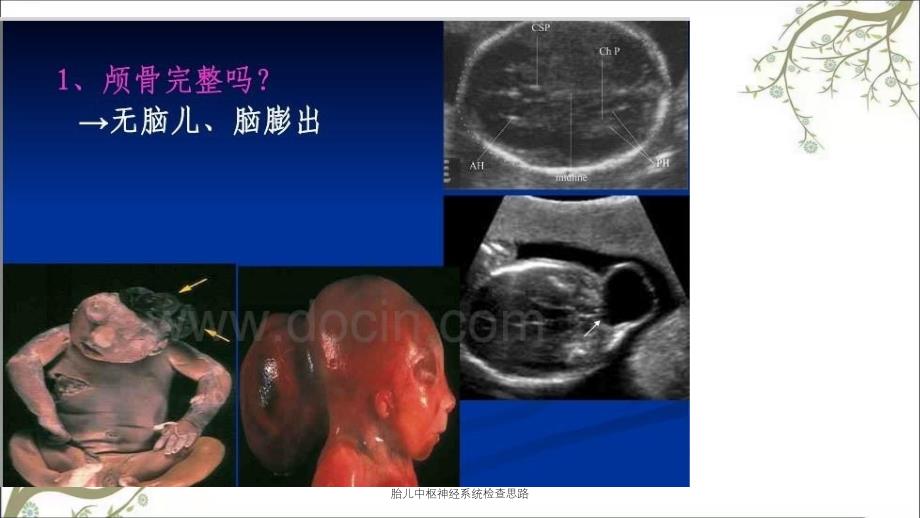 胎儿中枢神经系统检查思路课件_第3页